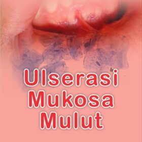 Ulserasi Mukosa Mulut